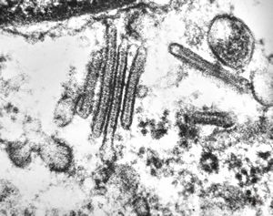 M, 7m. | hhistiocytosis X (eosinophilic granuloma) - Birbeck bodies M, 7m. | hhistiocytosis X (eosinophilic granuloma) - Birbeck bodies